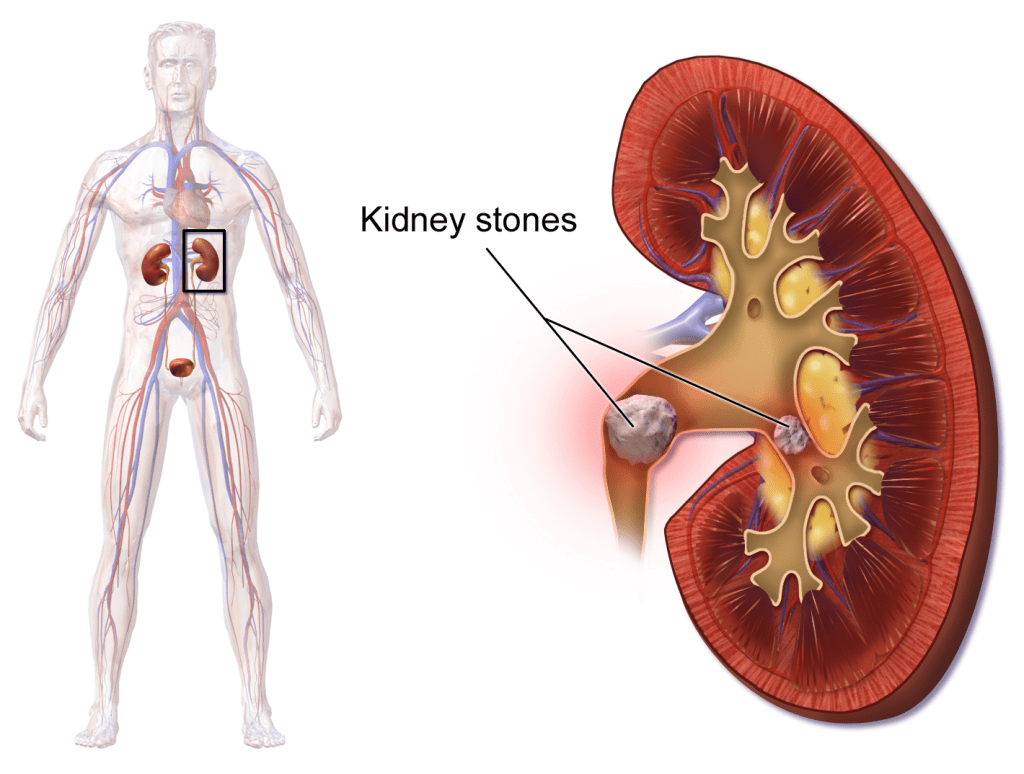 Blausen_0595_KidneyStones