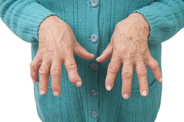 Rheumatoid Arthritis Hands 2