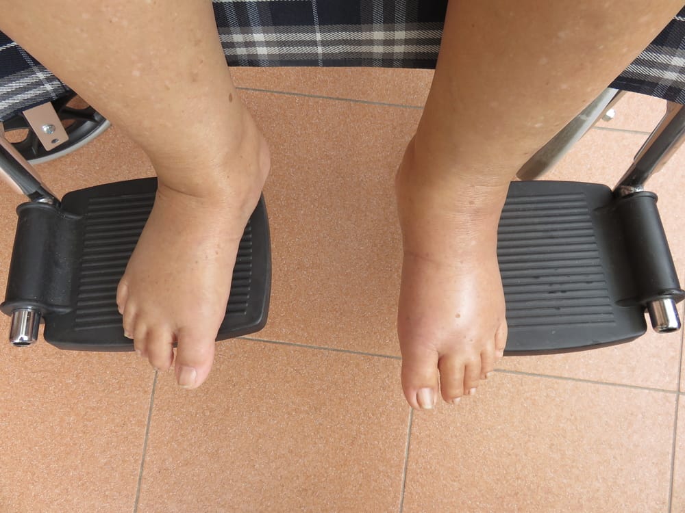 Elder,lady,with,leg,swelling,is,sitting,on,a,wheel