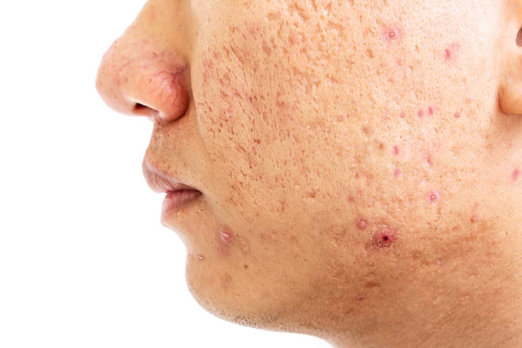 Close Up Of Problematic Skin With Deep Acne Scars On Cheek Men P