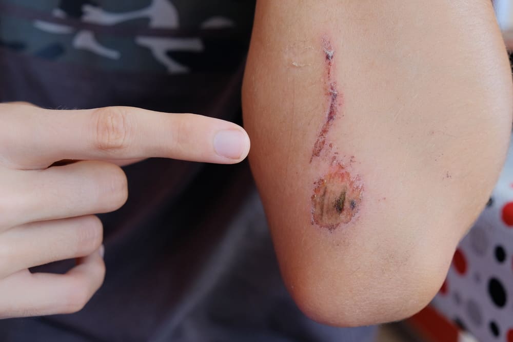 Body,injuries,,scratches,and,cuts,in,the,skin