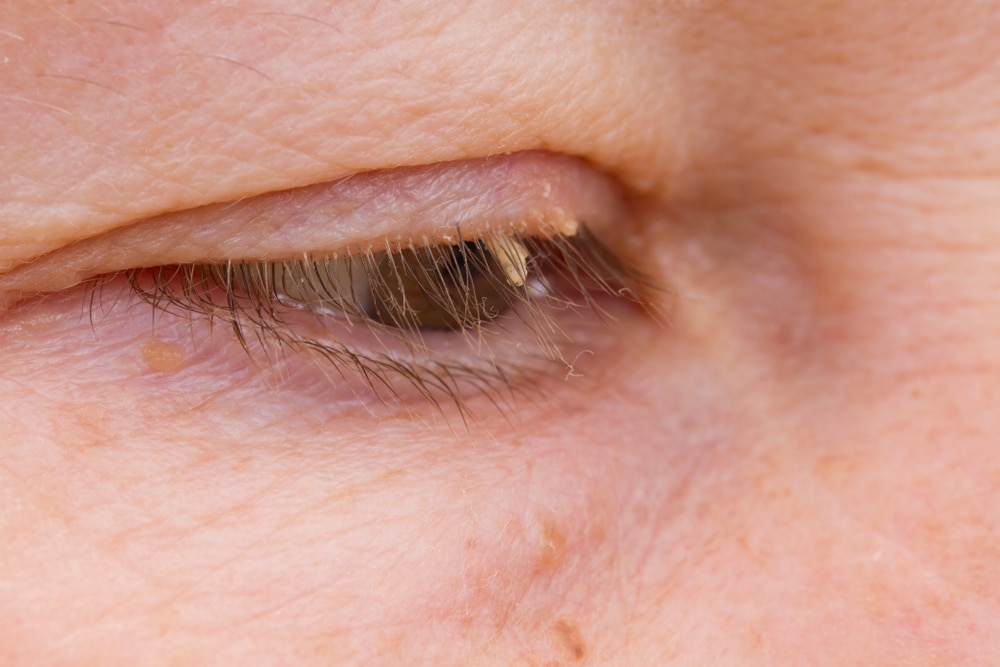 One,eye,close,up.,small,skin,tags,on,the,eyelids