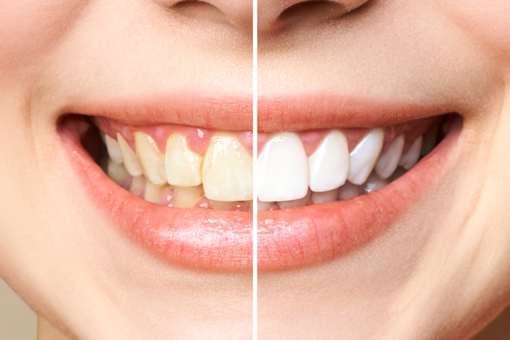 Woman,teeth,before,and,after,whitening.,over,white,background.,dental