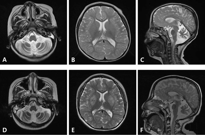 T2 Weighted Magnetic Resonance Imaging Of Galloway Mowat Syndrome With Novel Heterozygous.ppm