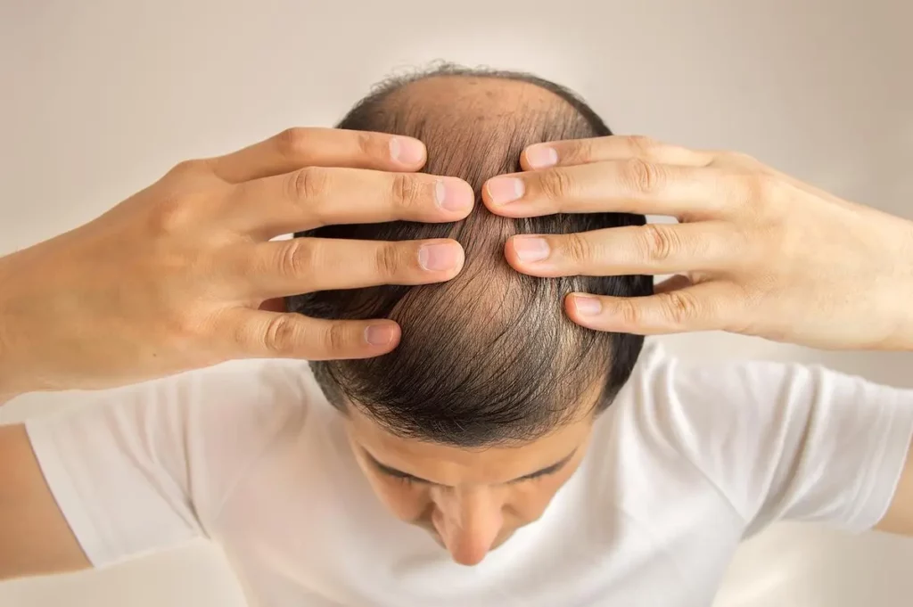 Hair Loss Men Heart Disease.jpg
