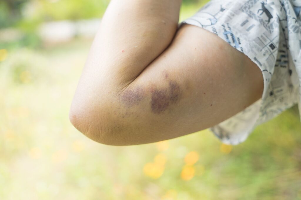 Close Up Bruising On The Old Woman Arm Woman Royalty Free Image 944987776 1562787481