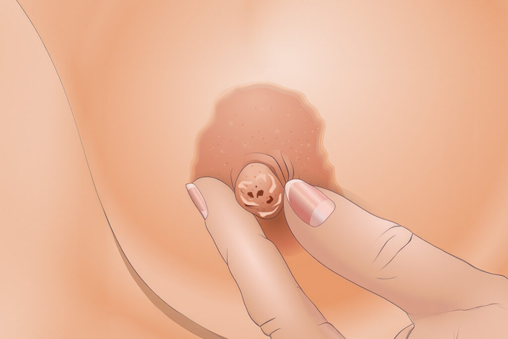 12 Scaling Or Peeling Of The Nipple Patedu.com