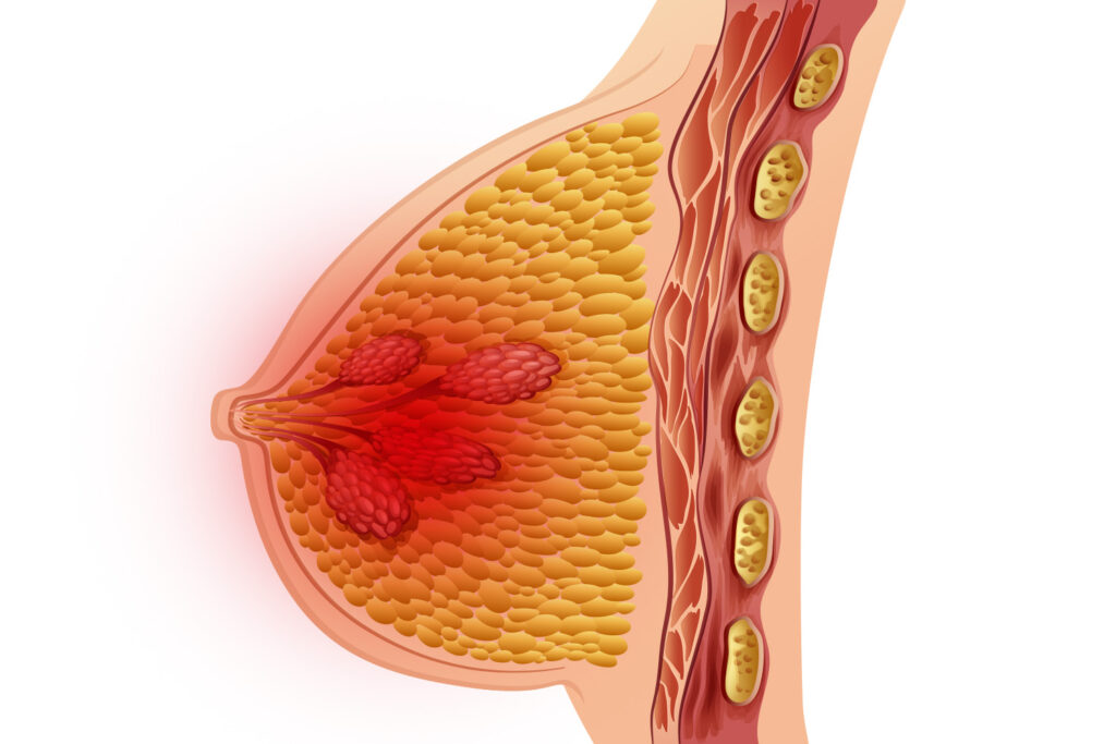 9 Thickening Of Breast Tissue Freepik
