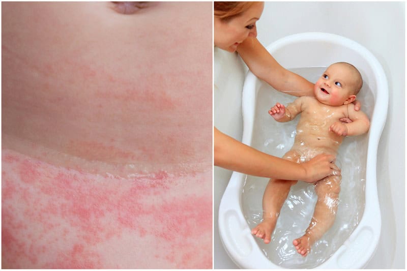 Diaper Rash Baby In Tub Not Just