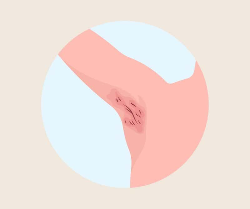 9. Swelling In The Armpit