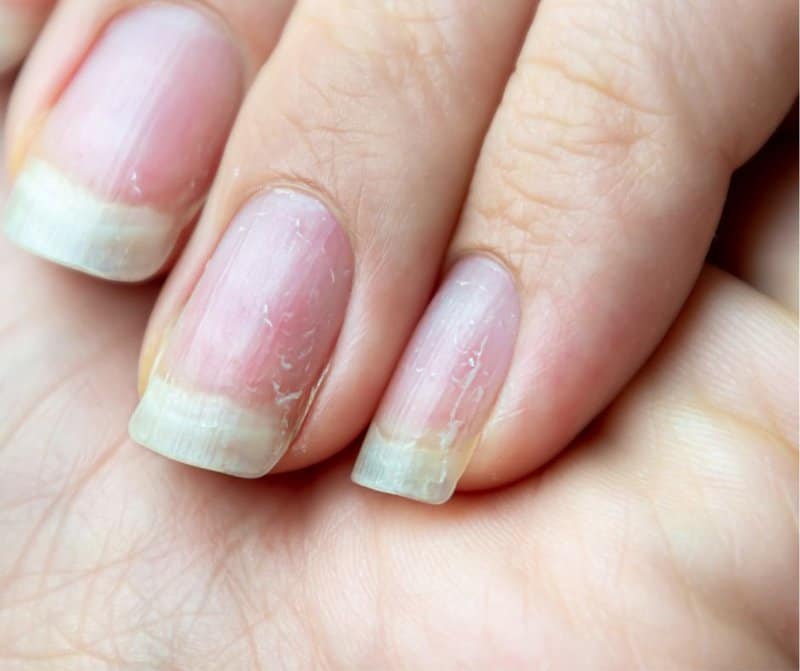 Clubbing Of Fingernails