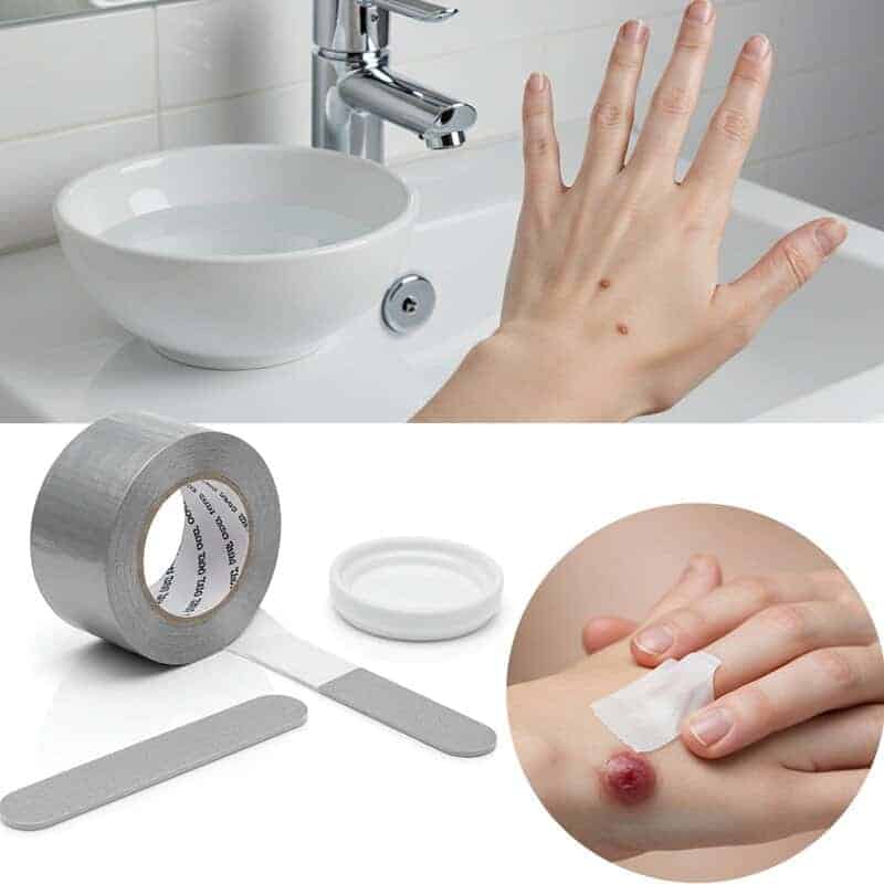 35. Duct Tape for Warts