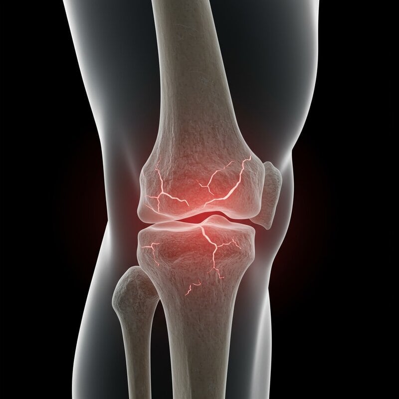 17. Unnoticed Fractures