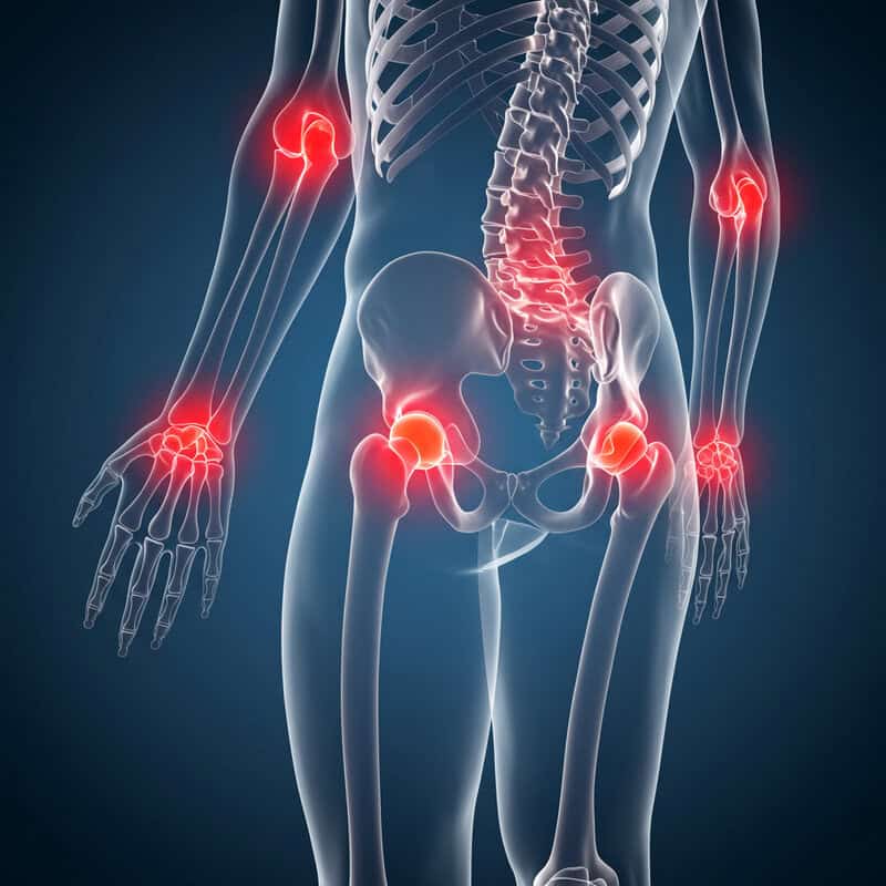 2. Understanding Arthritis Flare-Ups