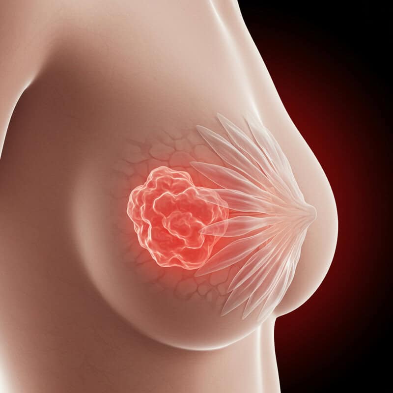 1. Lump in the Breast