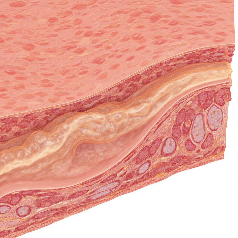 2. Thickening of Breast Tissue