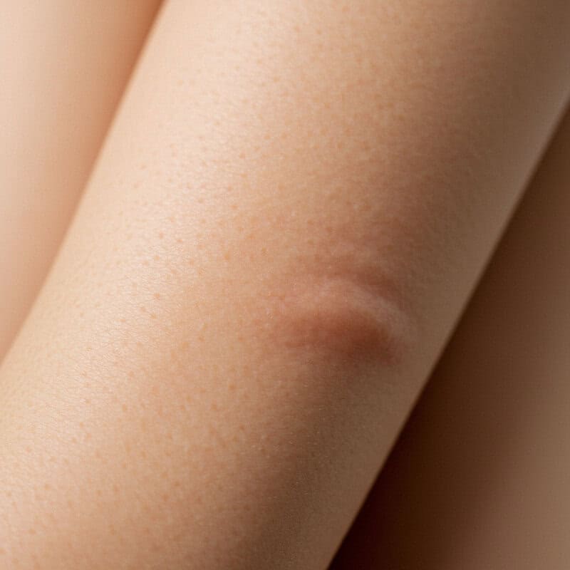 44. Changes in Skin Pigmentation