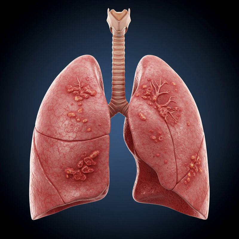 32. Prior Chest Infections