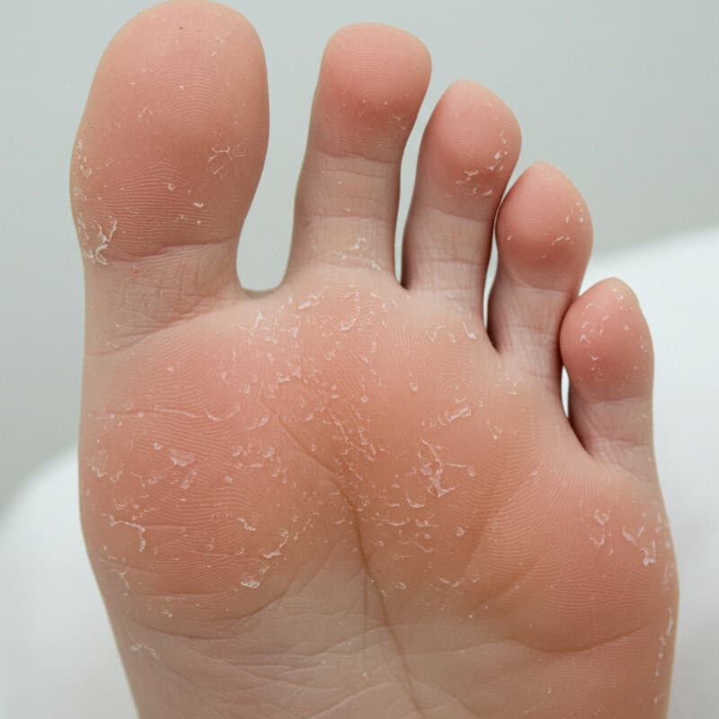 43. Dry or Peeling Skin on Feet