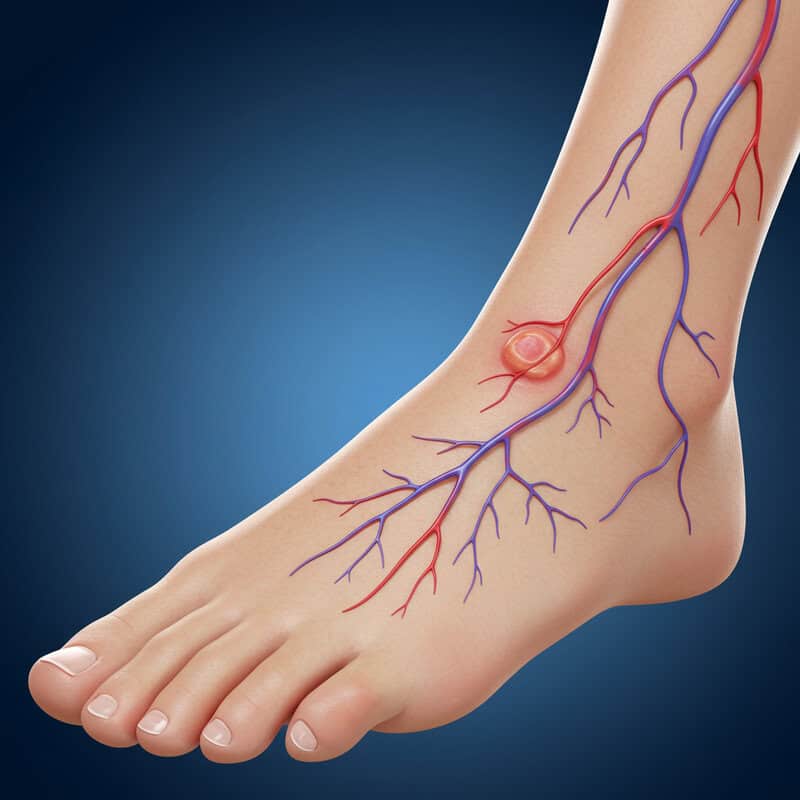 46. Slow-Healing Sores on Feet or Legs