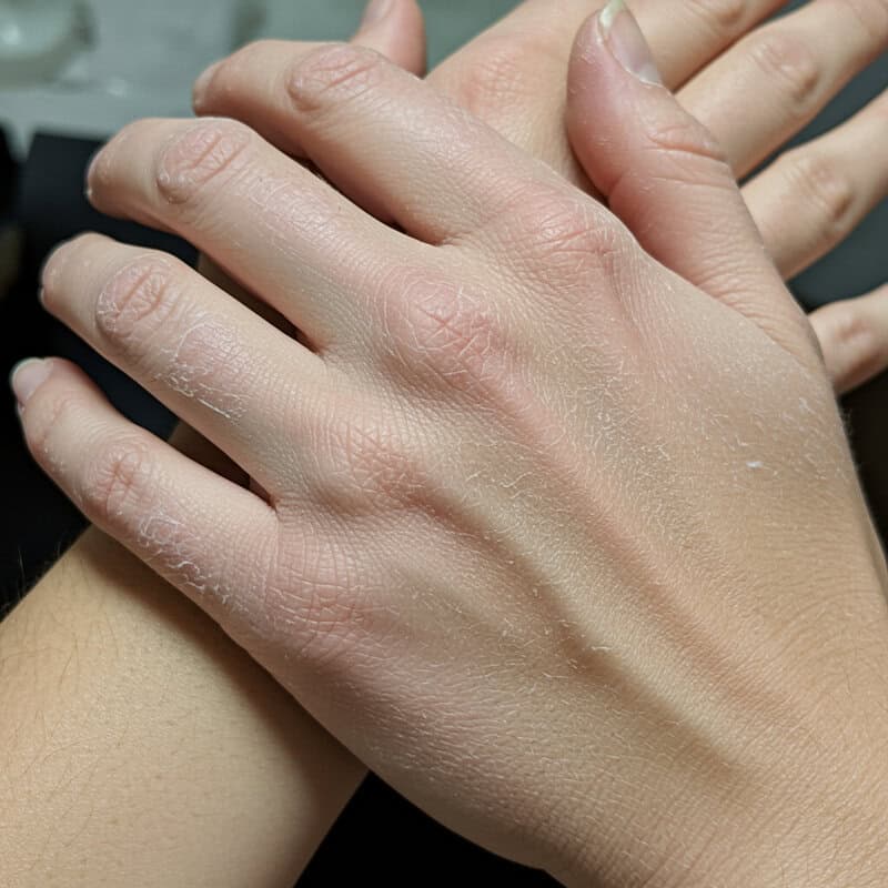 7. Dry Skin and Brittle Nails